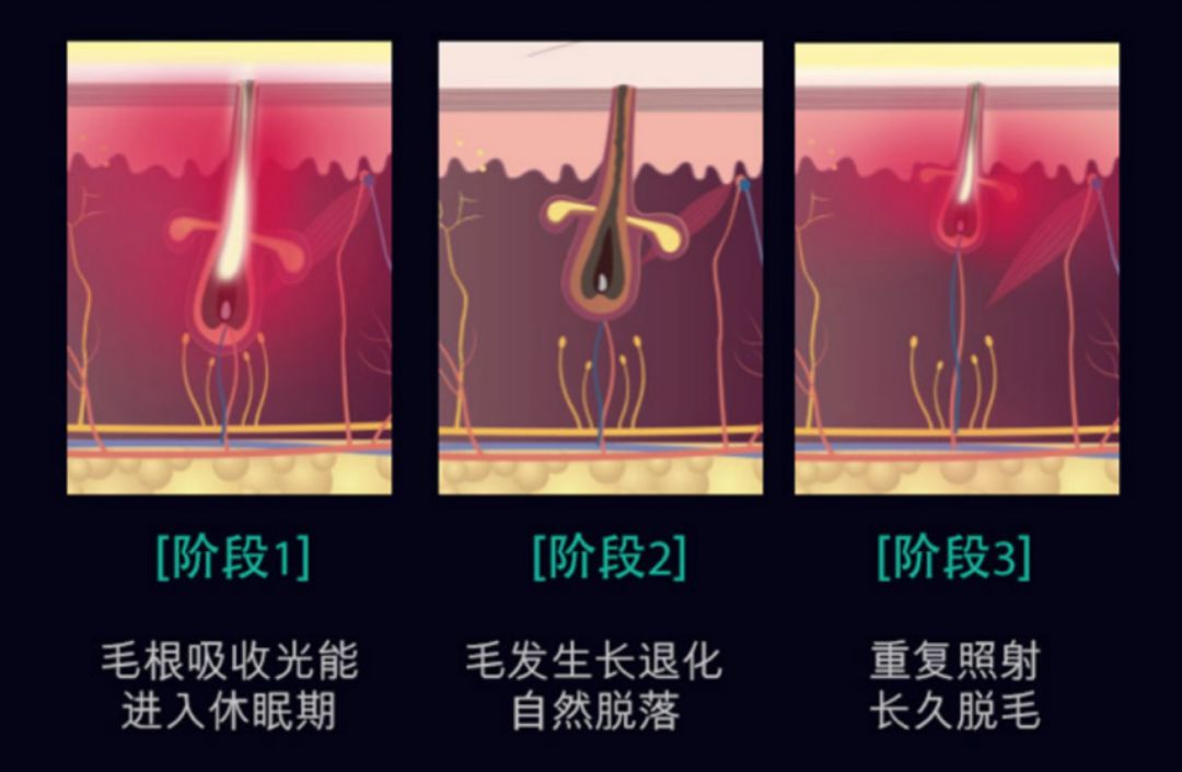 腿部脱毛的最佳方法,男性脱毛的最佳方法