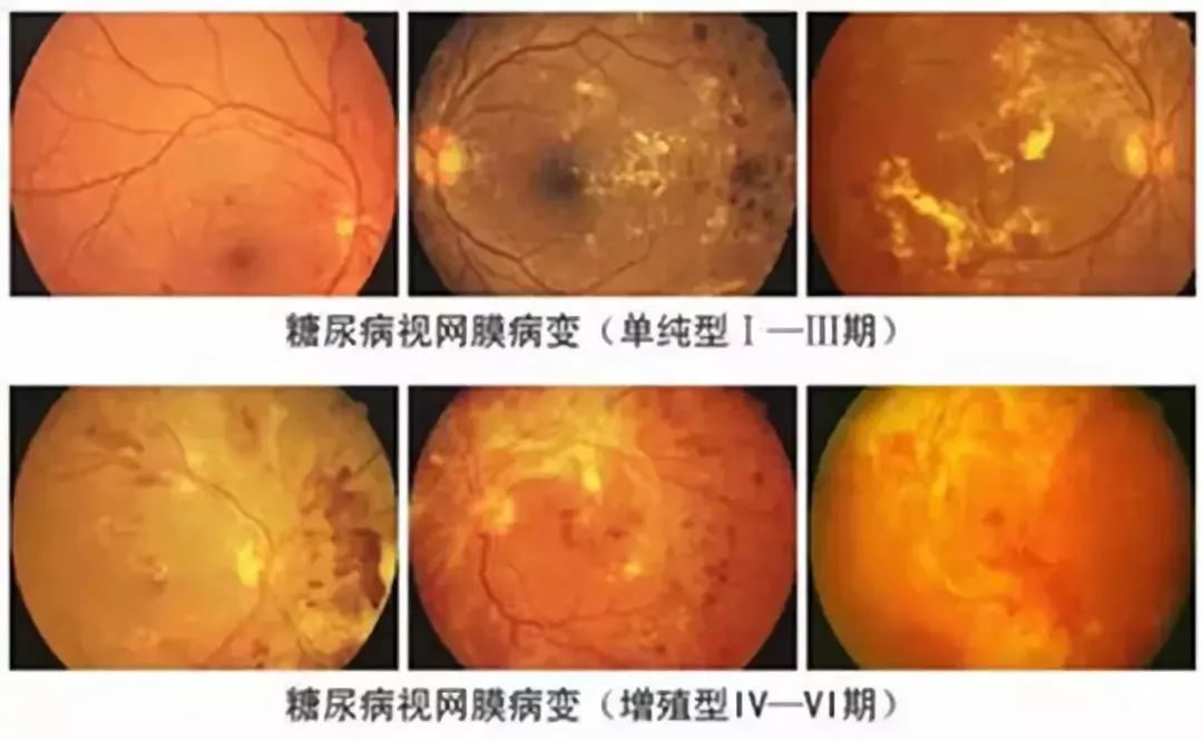叶黄素能改善糖尿病患者的视力吗,糖尿病视网膜病变吃叶黄素