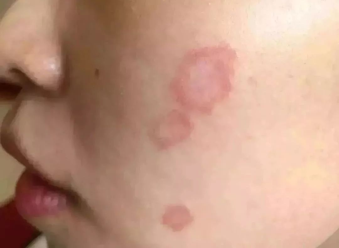 猫癣传染了给人该怎么办,人被传染上猫癣能用皮特芬吗