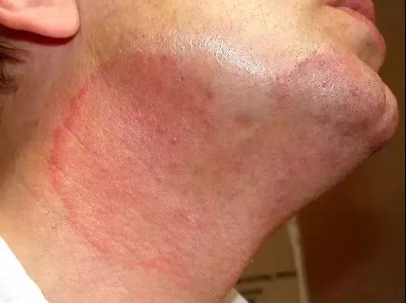 猫癣传染了给人该怎么办,人被传染上猫癣能用皮特芬吗