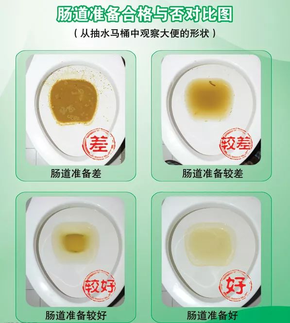 「话肿瘤」这个操作可发现早期肠癌