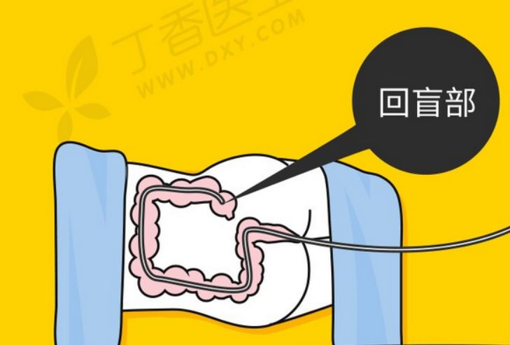 「话肿瘤」这个操作可发现早期肠癌