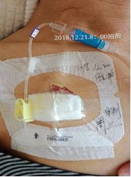 还在为静脉曲张发愁吗,输液港渗血处理方法