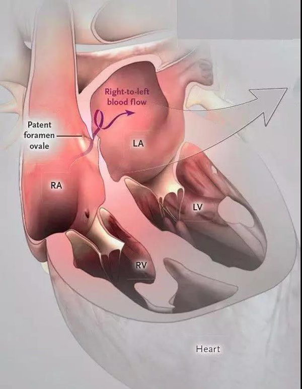 卵圆孔封堵术后脑梗复发几率,卵圆孔未闭封堵能治头痛吗
