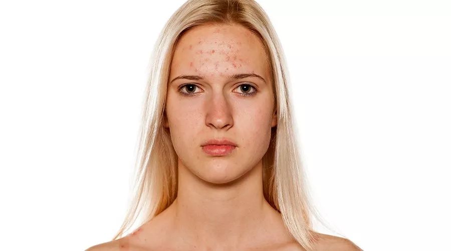 反复长痘是身体原因还是皮肤问题,青春期脸上的痘反复长是什么原因