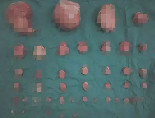 未婚女子肚子离奇变大,女子怀胎12个月肚子重大50斤