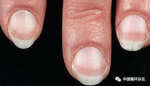 指甲代表肝功能吗,指甲病是肝不好吗
