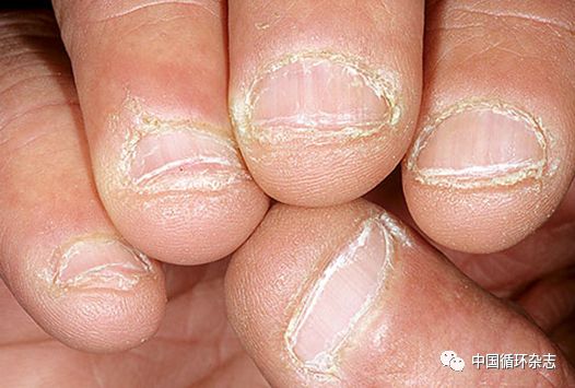 指甲代表肝功能吗,指甲病是肝不好吗