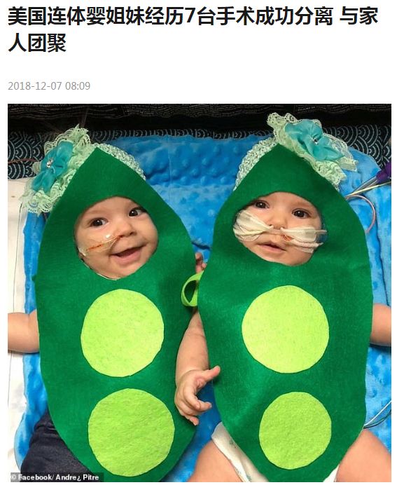 这对要上牛津剑桥的美女姐妹花，16年前是连体婴！存活率仅百万分之一