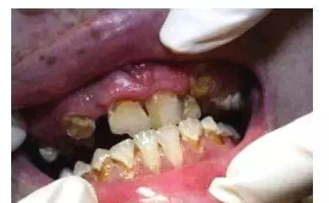 吸毒的牙齿是什么样子的,吸毒牙齿脱落