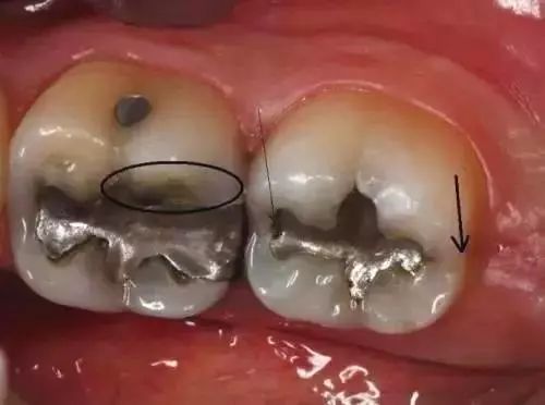 吸毒的牙齿是什么样子的,吸毒牙齿脱落