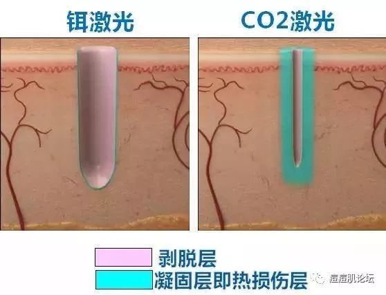 疮疤最快解决办法,痤疮疤痕痘坑怎么消除