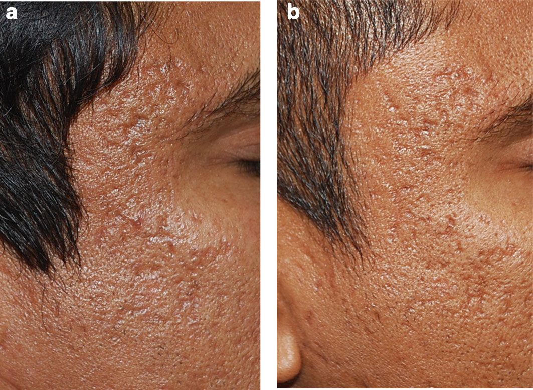 疮疤最快解决办法,痤疮疤痕痘坑怎么消除