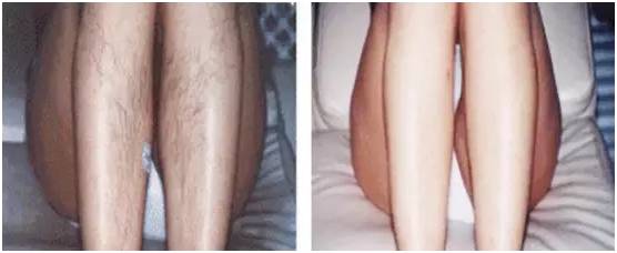 激光祛斑美容科普视频,激光美容有哪些优点和缺点