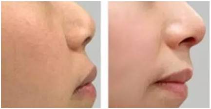 激光祛斑美容科普视频,激光美容有哪些优点和缺点