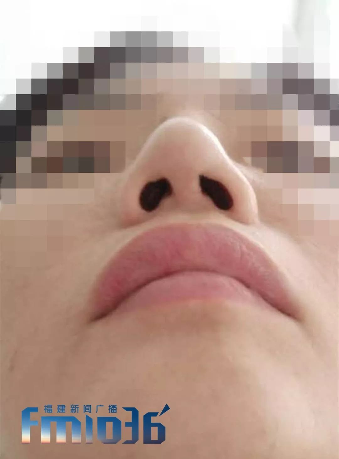 福州一女子整容失败,福州女子整形失败