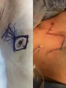 有哪些痣会被误认为黑色素瘤,什么样的痣容易变成黑色素瘤