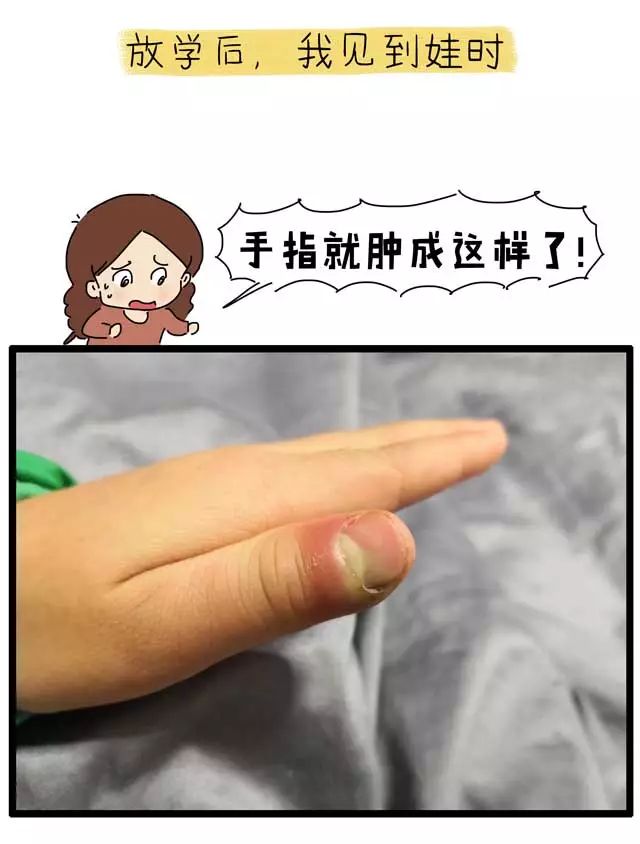 撕倒刺指甲化脓掉了,拔倒刺后指甲脱落