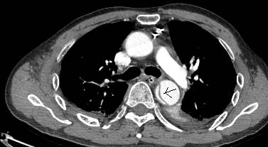 没有cta这三招也能识别主动脉夹层,磁共振可以替代cta检查主动脉夹层