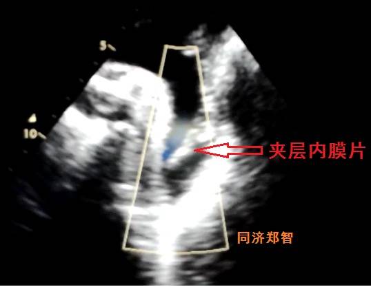 没有cta这三招也能识别主动脉夹层,磁共振可以替代cta检查主动脉夹层