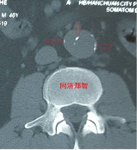 没有cta这三招也能识别主动脉夹层,磁共振可以替代cta检查主动脉夹层