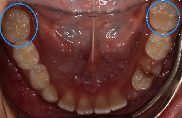 孩子龋齿？快看，福利来了！免费窝沟封闭活动正火热进行！