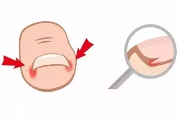 脚趾甲长进肉里不剪掉可以吗,脚趾甲长进肉里只剩一点掏不出来