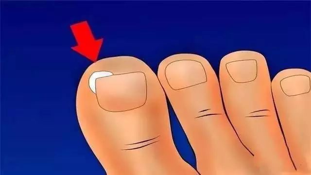 脚趾甲长进肉里不剪掉可以吗,脚趾甲长进肉里只剩一点掏不出来