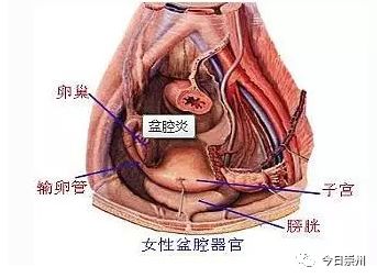 「崇州妇幼」女性下腹坠痛，多数都是它惹祸