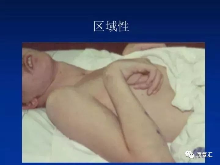 痉挛症可以治疗好吗,痉挛的康复