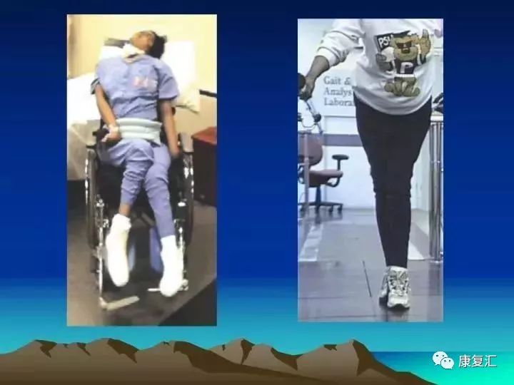 痉挛症可以治疗好吗,痉挛的康复