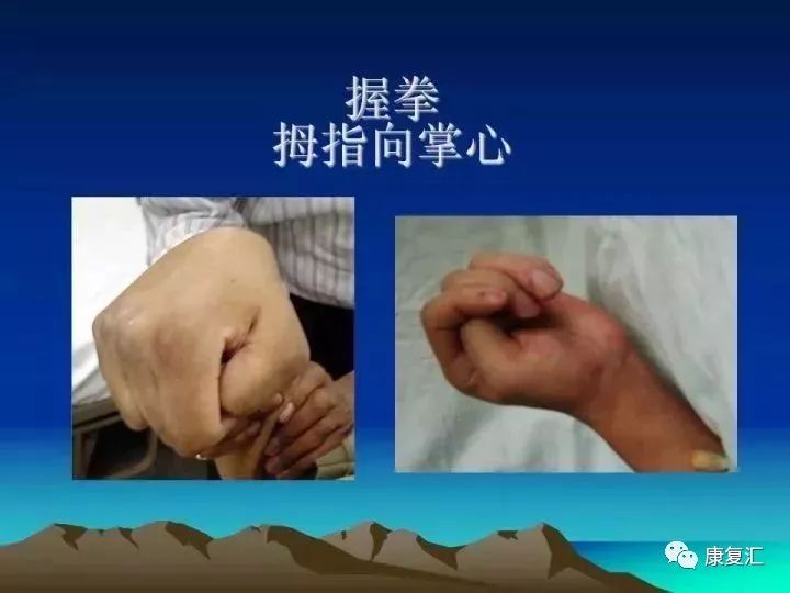 痉挛症可以治疗好吗,痉挛的康复