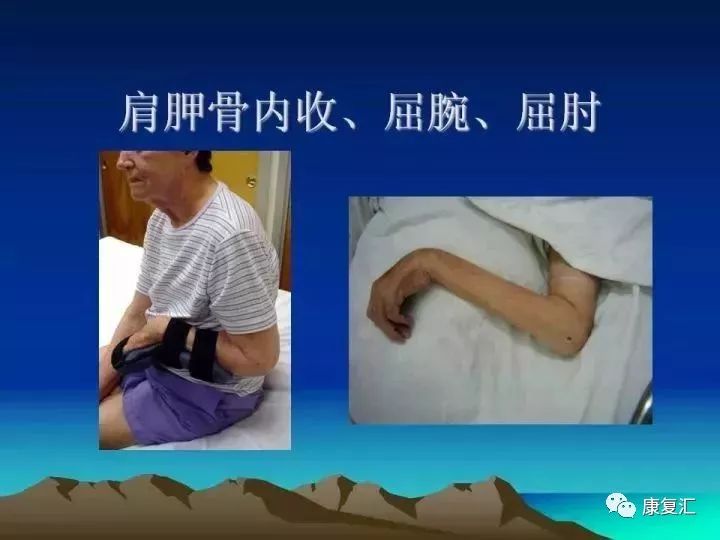 痉挛症可以治疗好吗,痉挛的康复