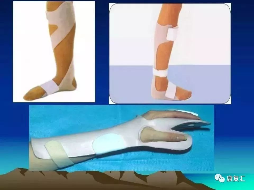 痉挛症可以治疗好吗,痉挛的康复