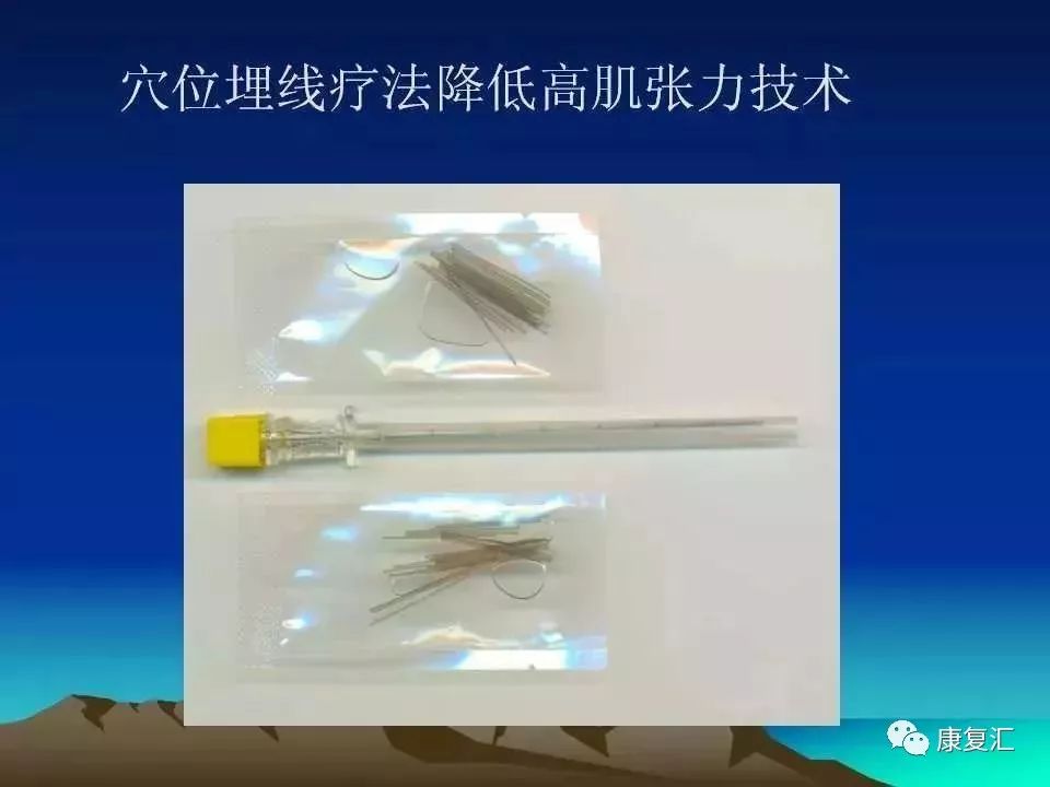 痉挛症可以治疗好吗,痉挛的康复