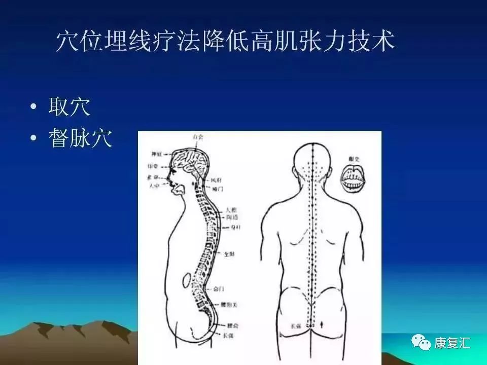 痉挛症可以治疗好吗,痉挛的康复