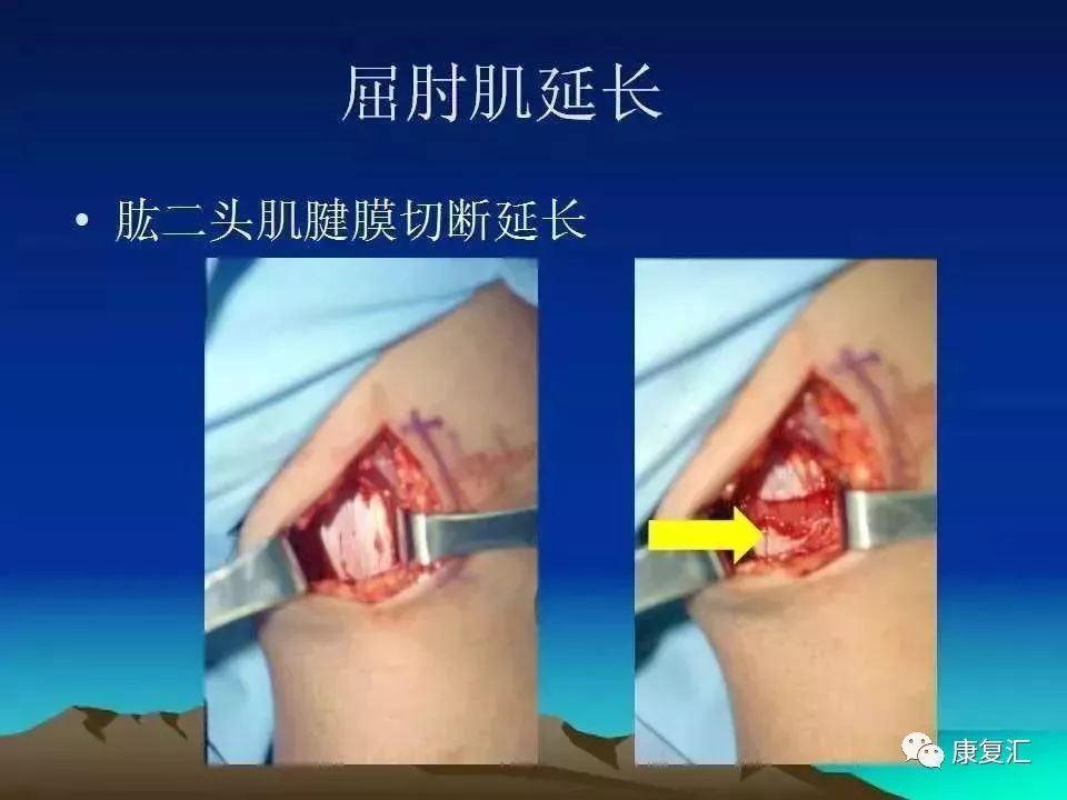 痉挛症可以治疗好吗,痉挛的康复