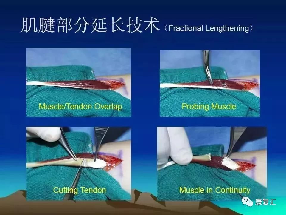 痉挛症可以治疗好吗,痉挛的康复