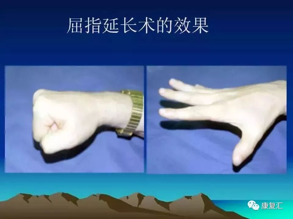 痉挛症可以治疗好吗,痉挛的康复