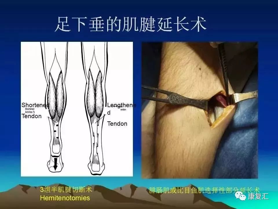 痉挛症可以治疗好吗,痉挛的康复