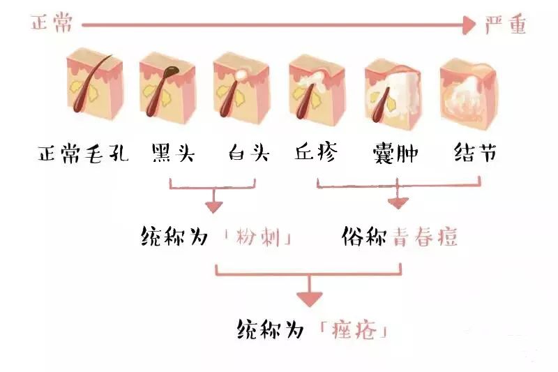 痘痘肌必买药膏有哪些牌子,痘痘肌必看五种痘痘类型