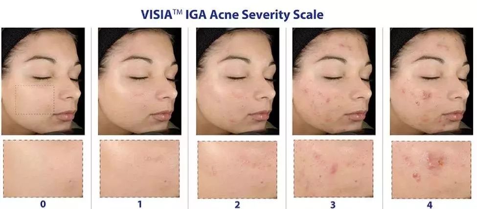 痘痘肌必买药膏有哪些牌子,痘痘肌必看五种痘痘类型