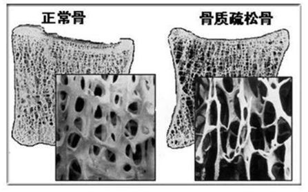 「筋骨堂」骨质疏松症该如何防治？