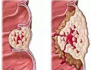 20年烟民咽喉发黑,瑞士专业医师推荐!一喷杀菌99.9%,止咳清痰排烟毒