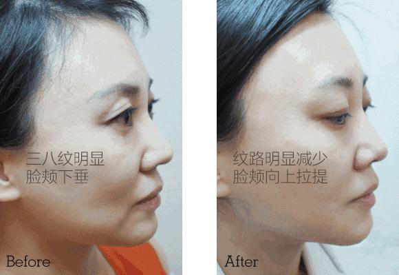 6d线雕提拉童颜术,不打针不开刀祛皱纹的轻医美
