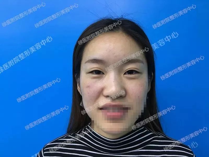 双眼皮失败又不想修复怎么办,双眼皮失败修复方法如下