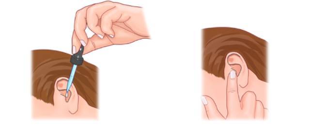 滴耳液后要进行10分钟耳浴啥意思,诺氟沙星滴耳液怎么进行耳浴