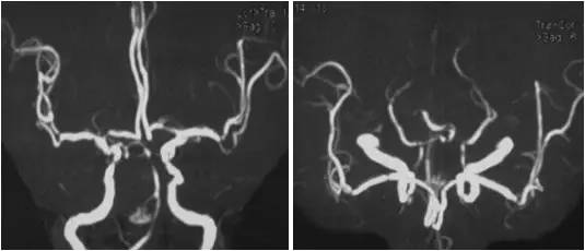 基底动脉狭窄介入治疗的病例分享,天坛医院颈动脉闭塞的介入治疗