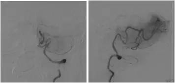 基底动脉狭窄介入治疗的病例分享,天坛医院颈动脉闭塞的介入治疗