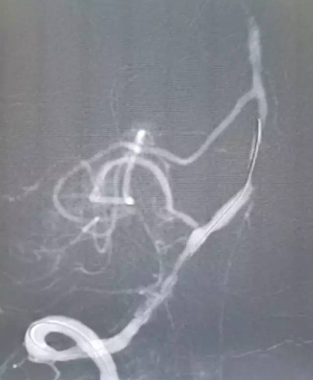 基底动脉狭窄介入治疗的病例分享,天坛医院颈动脉闭塞的介入治疗